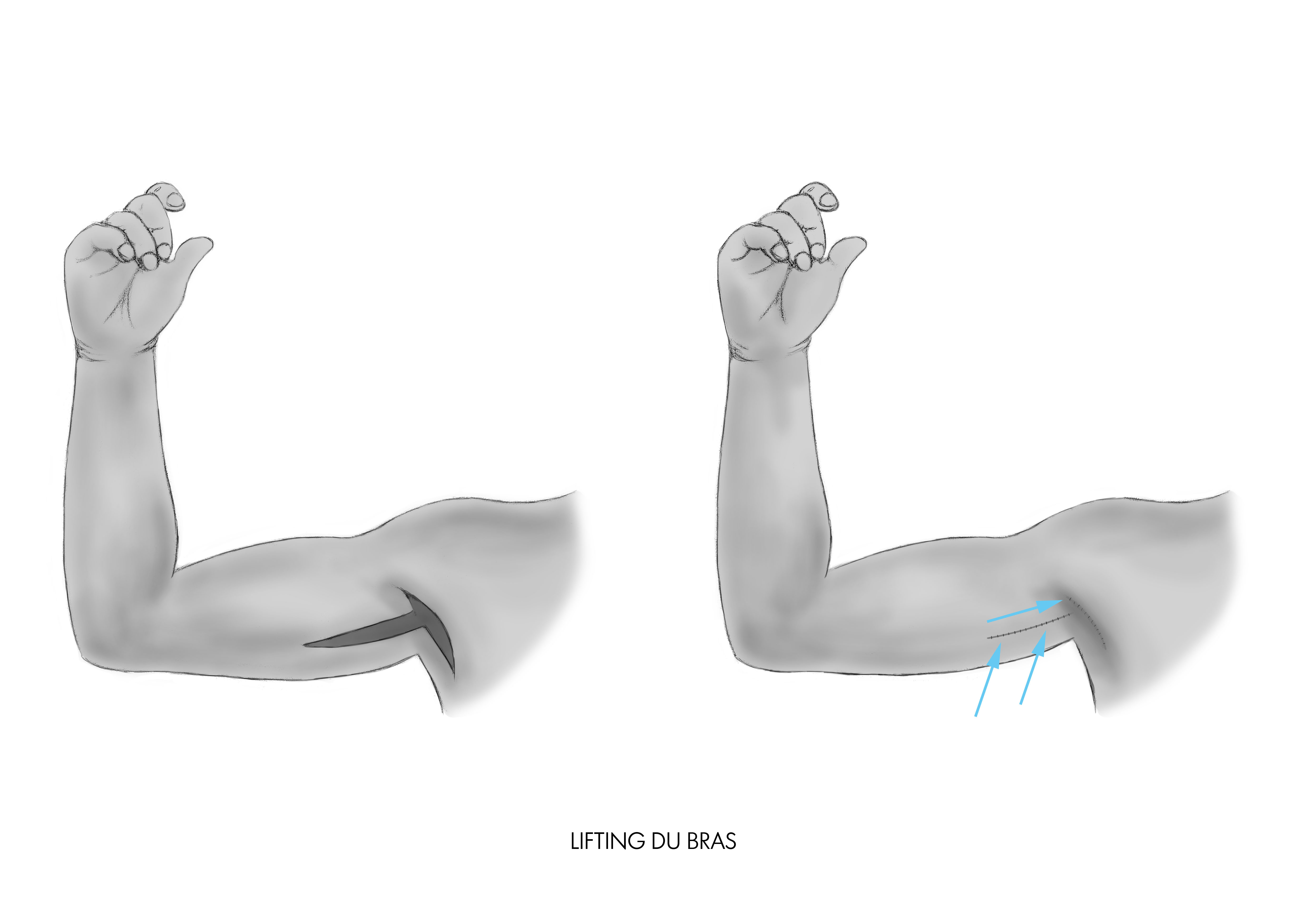 L’élimination de l’excès de la peau des bras par le lifting à paris, Dr Marsili