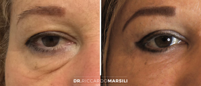 Marsili-blepharoplastie-avant-apres La blépharoplastie : Rajeunissement du regard et des paupières à paris