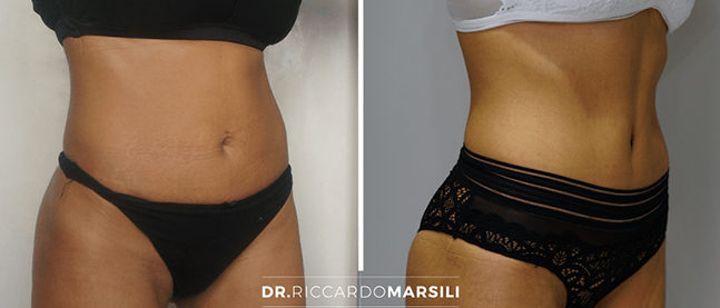 abdominoplastie-plastie-abdominale-dr-marsili Plastie abdominale - Chirurgie du ventre à Paris