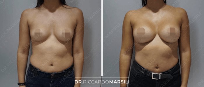 Dual plan avant après Augmentation poitrine avant et après