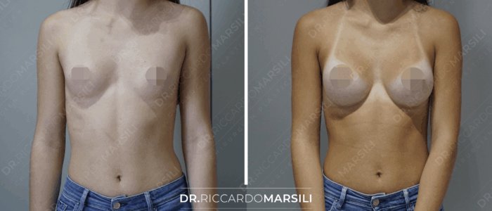 Augmentation mammaire avant et après Augmentation mammaire Paris, prix, devis, tarif