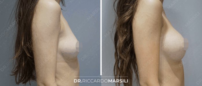 Augmentation mammaire avant après 2022 Augmentation mammaire avant et après 2022