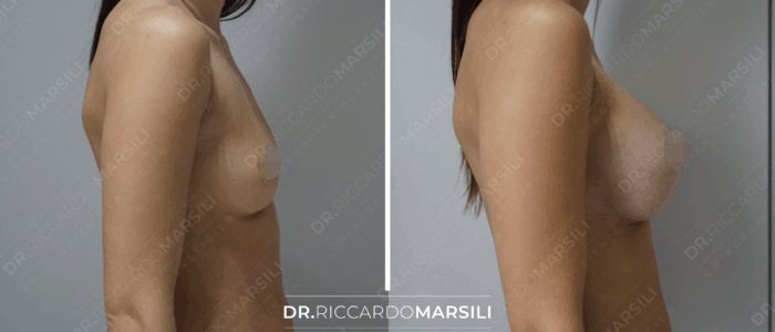 Avant et après augmentation mammaire Augmentation mammaire avant après photos