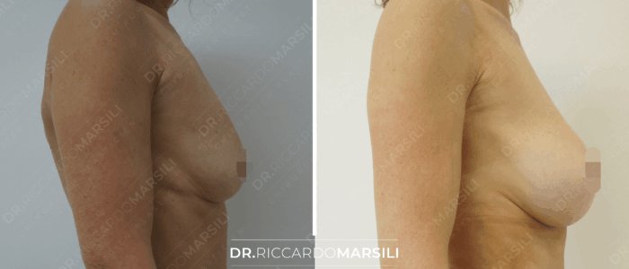 Augmentation mammaire avant après Augmentation mammaire avant et après 2022