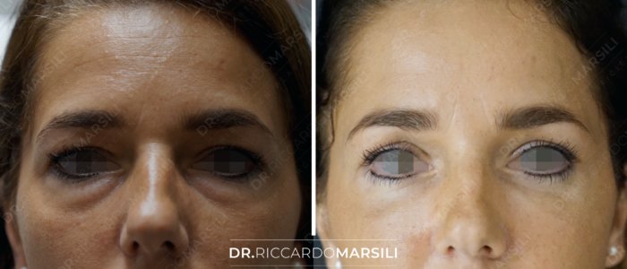 avant-apres-blepharoplastie-chirurgie-regard-dr-marsili-paris Blépharoplastie Paris