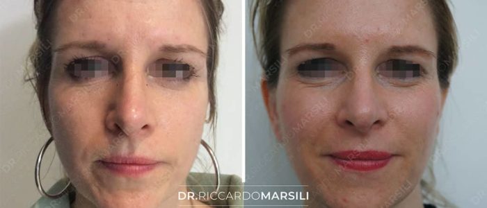 avant-apres-lifting-visage-sans-chirurgie-1-dr-marsili avant apres lifting visage sans chirurgie 1 dr marsili