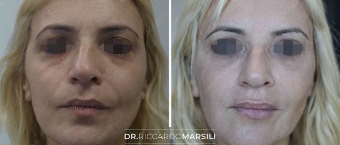 avant-apres-lifting-visage-sans-chirurgie-2-dr-marsili avant apres lifting visage sans chirurgie 2 dr marsili