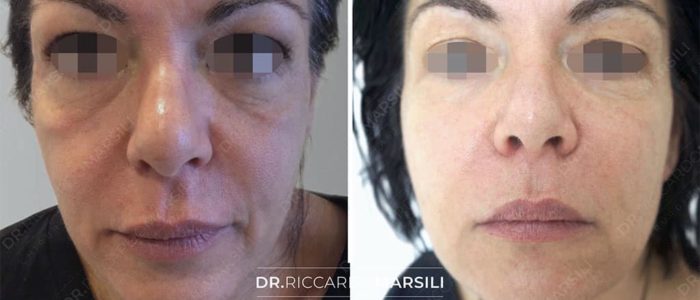 avant-apres-lifting-visage-sans-chirurgie-4-dr-marsili avant apres lifting visage sans chirurgie 4 dr marsili