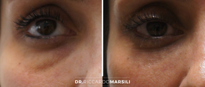 blepharoplastie-dr-riccardo-marsili-avant-apres Blépharoplastie à Paris - Photo avant après | Dr Marsili