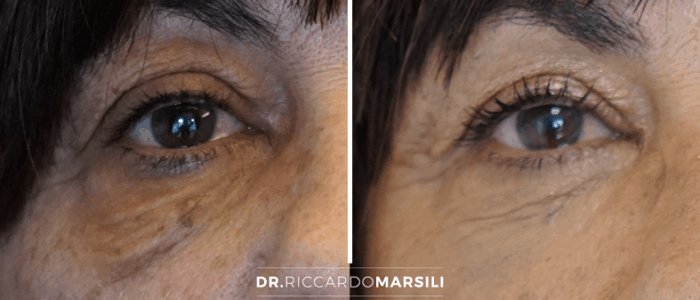 chirurgie-des-paupieres-blepharoplastie-dr-marsili Blépharoplastie Paris
