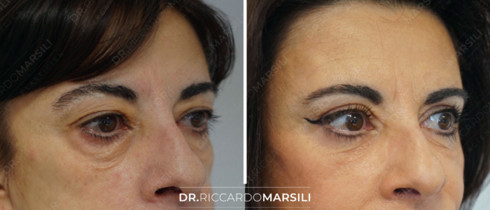 chirurgie-du-regard-dr-marsili-chirurgien-plasticien-et-esthetique-paris Blépharoplastie Paris, se lancer en 2022