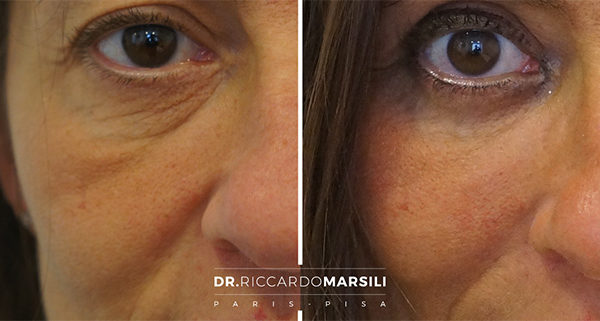 Blépharoplastie Paris