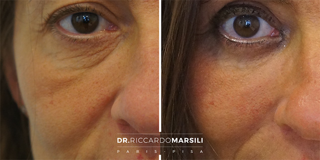 Blépharoplastie Paris