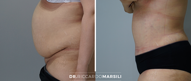 dr-marsili-abdominoplastie-plastie-abdominale Abdominoplastie Paris