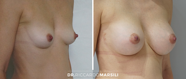 dr-marsili-augmentation-mammaire-dual-prothese-lipofilling Augmentation mammaire Dual Plan