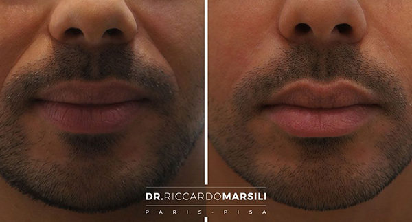 Masculinisation du visage 1 Acide hyaluronique Paris - Lèvres