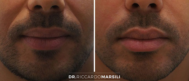 dr-marsili-injection-acide-hyaluronique-levres Acide hyaluronique Paris - Lèvres