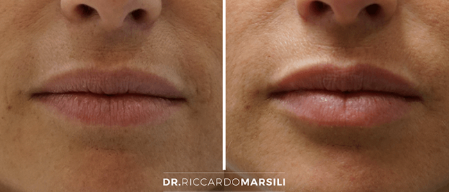 injection-acide-hyaluronique-levres-dr-marsili Injection dans les lèvres d'acide hyaluronique à Paris | Dr Marsili