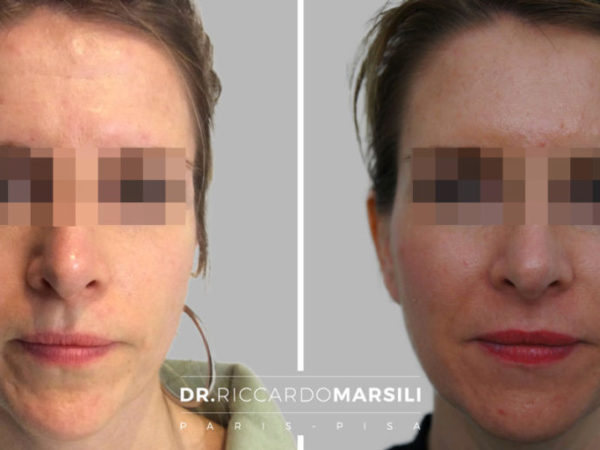 Lipofilling visage Paris