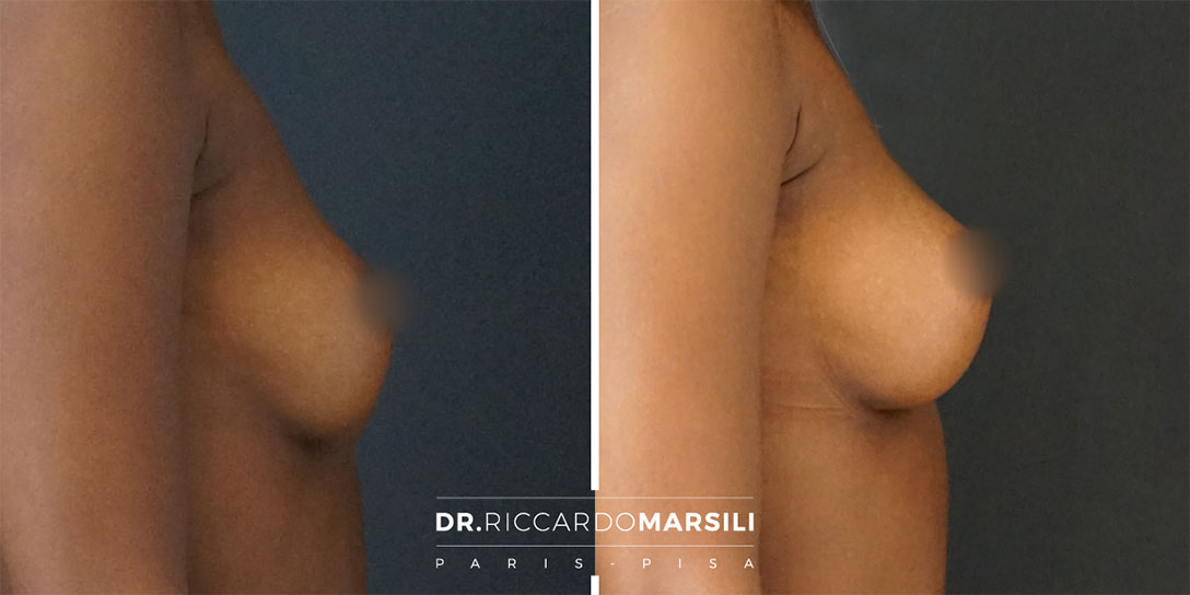 Lipofilling mammaire à Paris