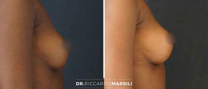 lipofilling-mammaire-dr-marsili-paris Lipofilling Mammaire