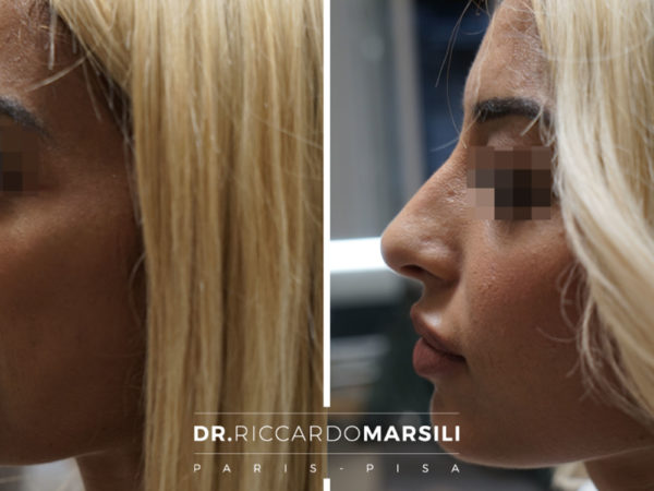 Rhinoplastie médicale Paris
