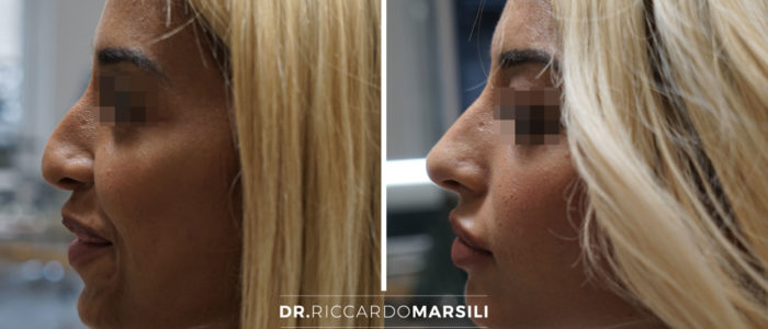 photo-avant-apres-rhinoplastie-medicale-acide-hyaluronique-dr-marsili-paris Rhinoplastie médicale Paris