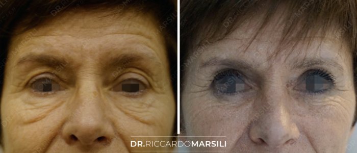 resultat-avant-apres-blepharoplastie-dr-marsili-paris Blépharoplastie Paris 75016