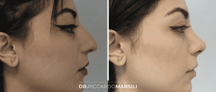 rhinoplastie-avant-apres-dr-marsili-chirurgien-esthetique-paris Rhinoplastie Paris, se lancer en 2022