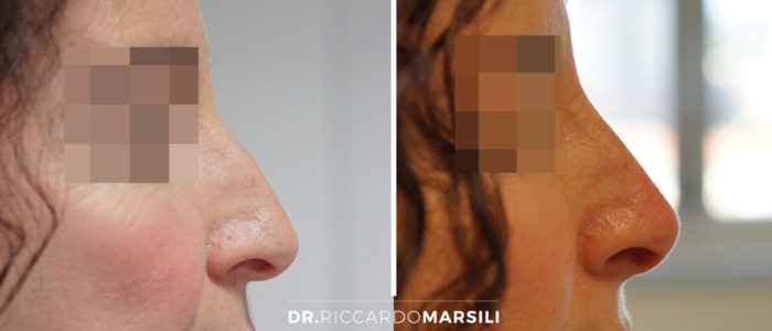 rhinoplastie-medicale-avant-apres-dr-marsili Rhinoplastie médicale à Paris - Avant et Après | Dr Marsili
