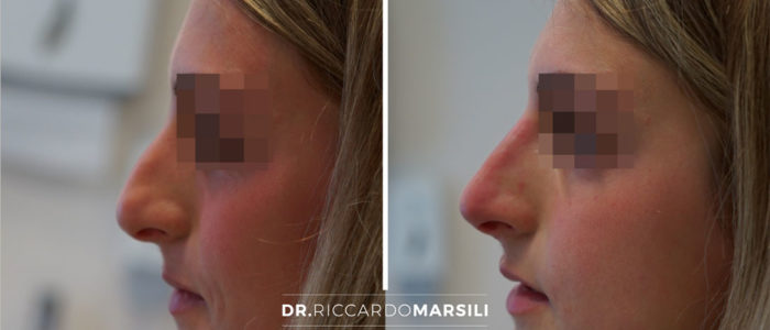 rhinoplastie-medicale-injection-acide-hyaluronique-dr-marsili Acide hyaluronique nez