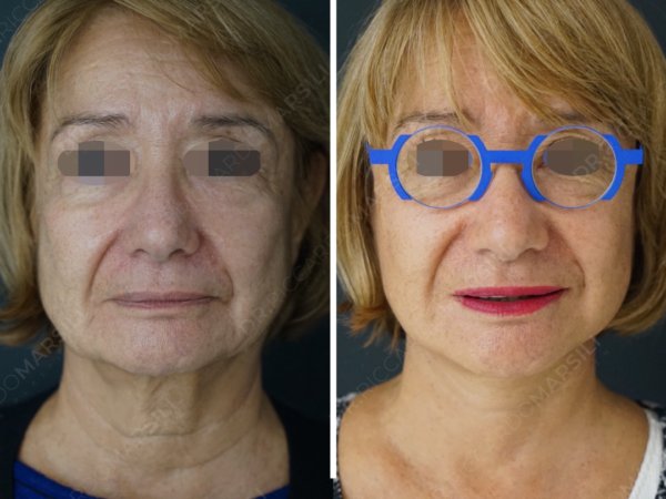 Lifting visage Paris