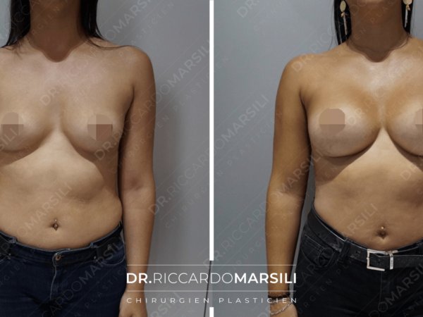Augmentation poitrine avant et après