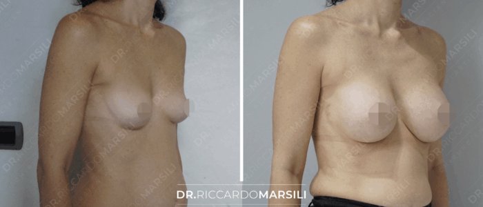 Augmentation mammaire Paris avant et après