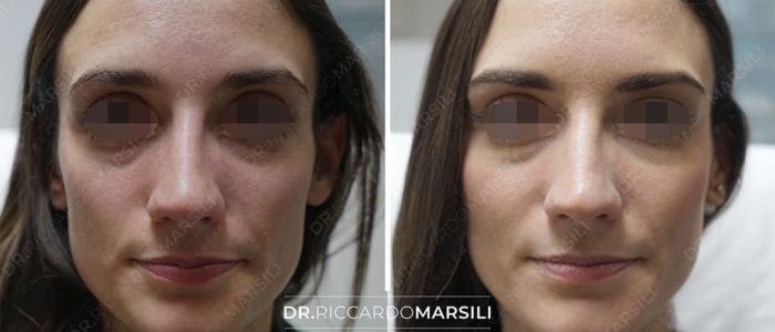 avant-apres-lifting-visage-sans-chirurgie-5-dr-marsili Lifting Visage Paris, prix, devis, tarif