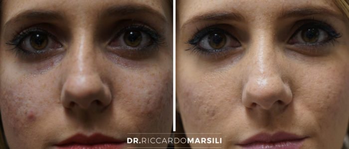 avant-apres-correction-cernes-dr-marsili-paris Correction cernes Paris