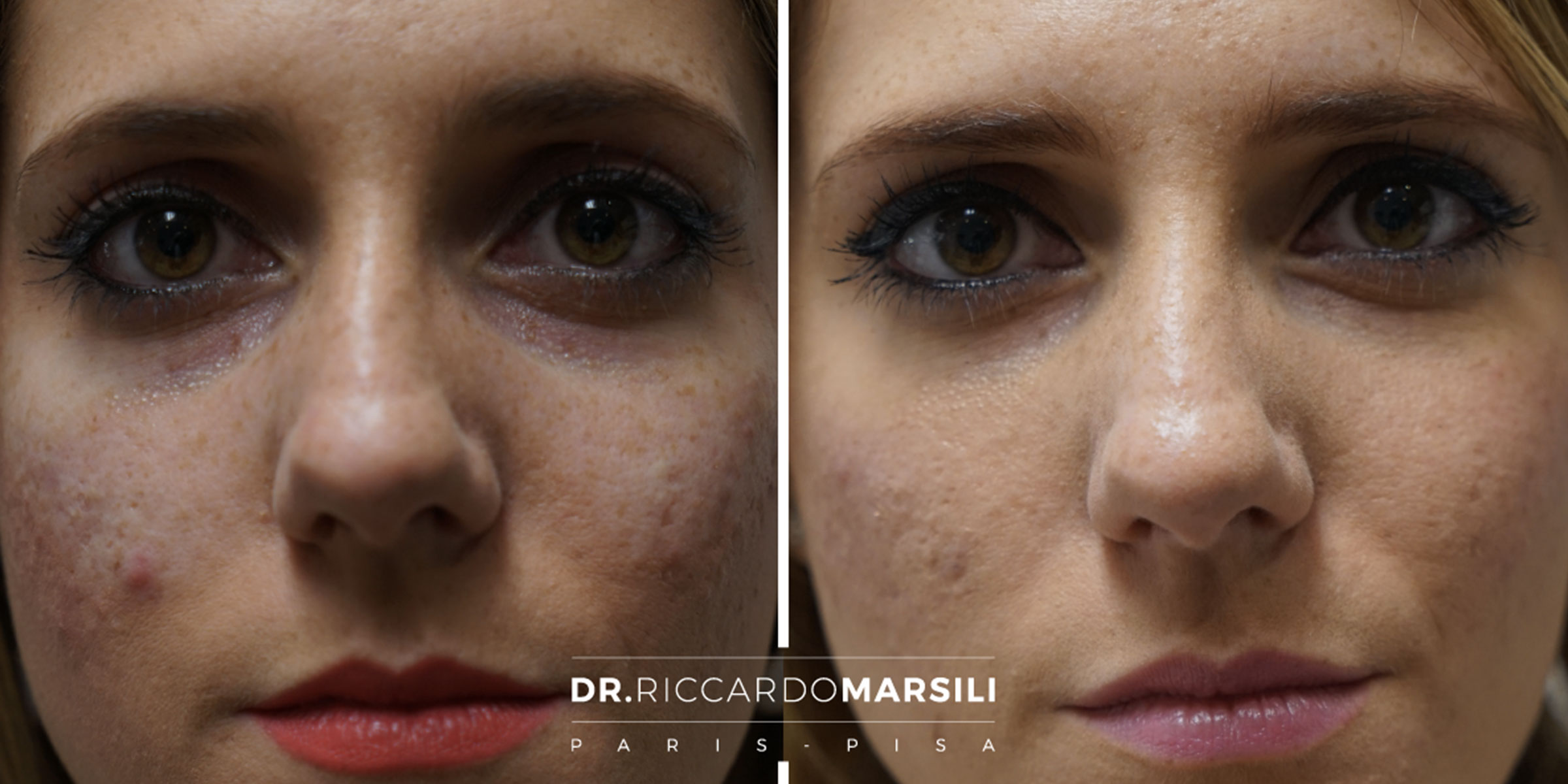 Correction cernes Paris