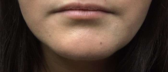 injection-acide-hyaluronique-levres-dr-riccardo-marsili-paris Injection de l’acide hyaluronique à paris, pour l'embellissement des lèvres, Dr Marsili