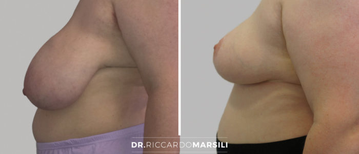lifting-seins-mastopexie-dr-riccardo-marsili Le lifting des seins à paris par La mastopexie , Dr Marsili
