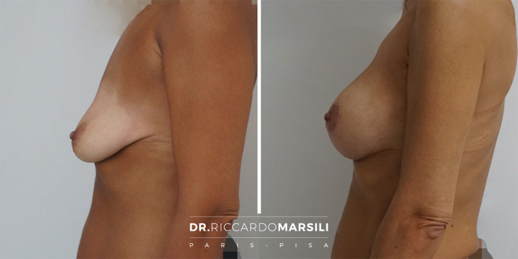 Lifting mammaire avant après