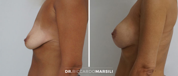 lifting-mammaire-mastopexie-dr-marsili-paris Lifting mammaire avant après