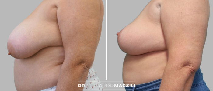 chirurgie-mammaire-mastopexie-dr-riccardo-marsili-paris Obtenir des seins en harmonie avec le lifting mammaire à paris, Dr Marsili