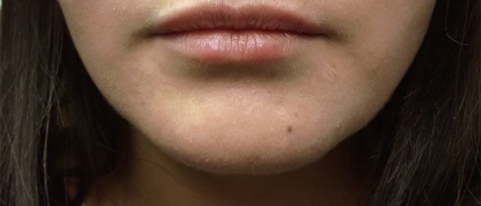 Embellissement des lèvres :Injection de l’acide hyaluronique à paris, Dr Marsili