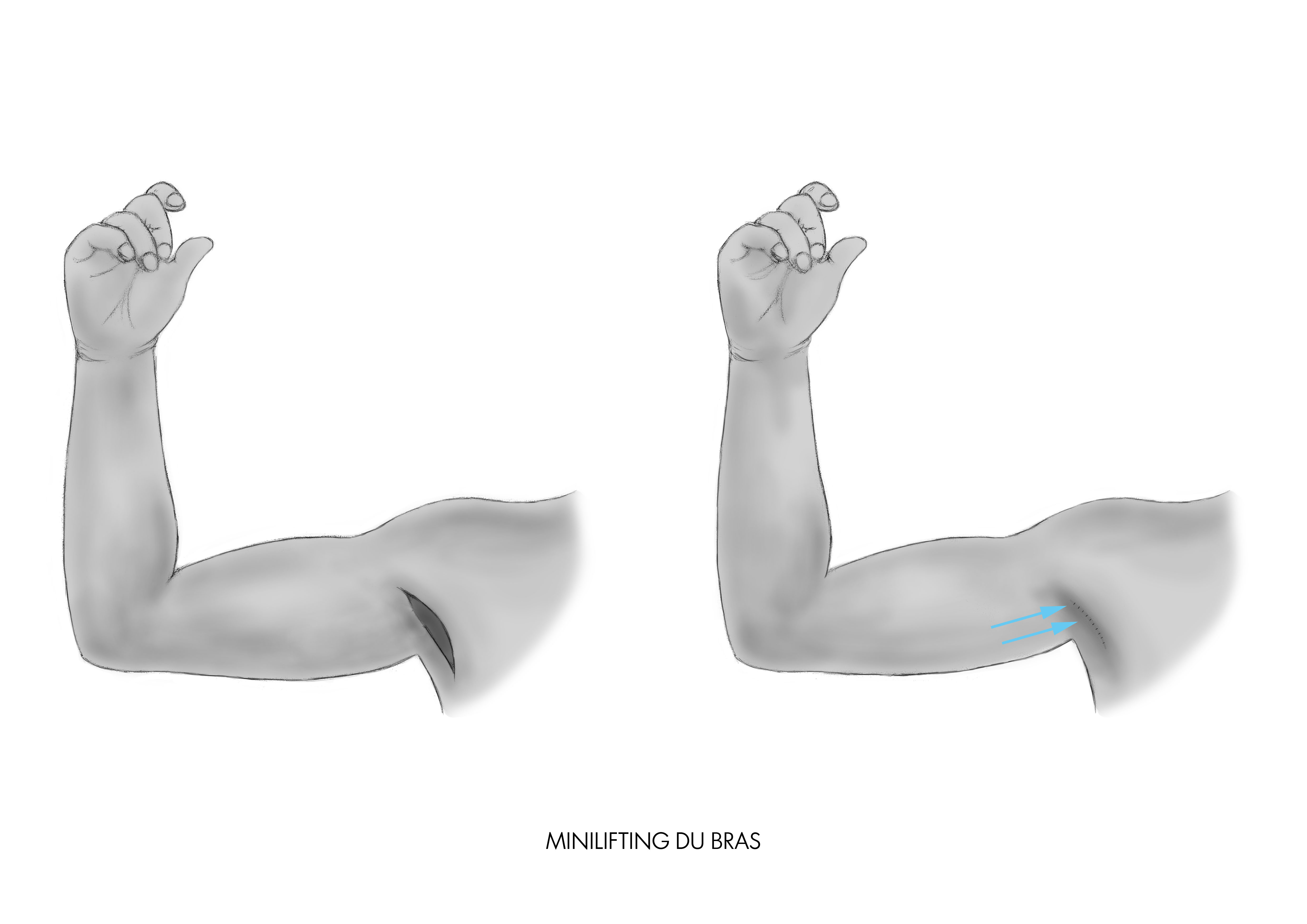 Le minilifting des bras à paris par Dr Riccardo Marsili