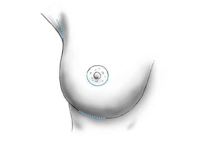 L'augmentation de la taille des seins par l'implantation des implants mammaires à paris, Dr Marsili