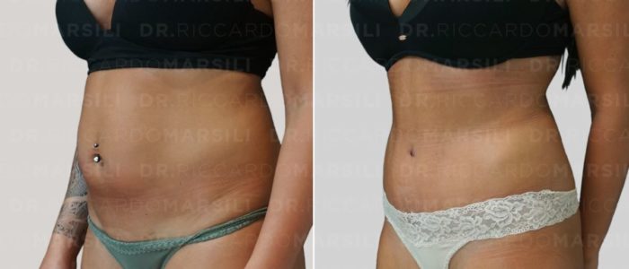 chirurgie-abdominoplastie-dr-riccardo-marsili-paris Abdominoplastie Paris 75016