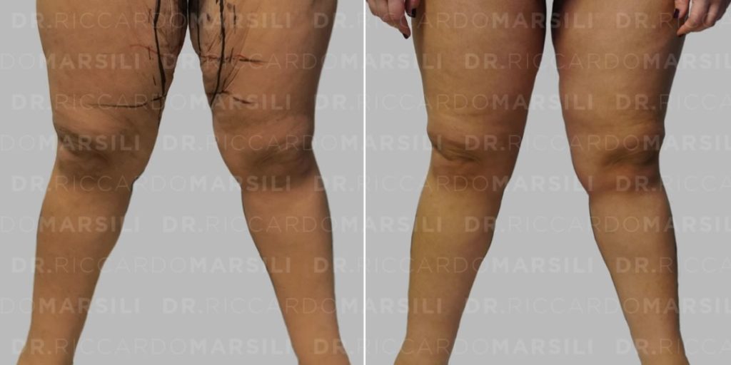 Lifting cuisses Paris