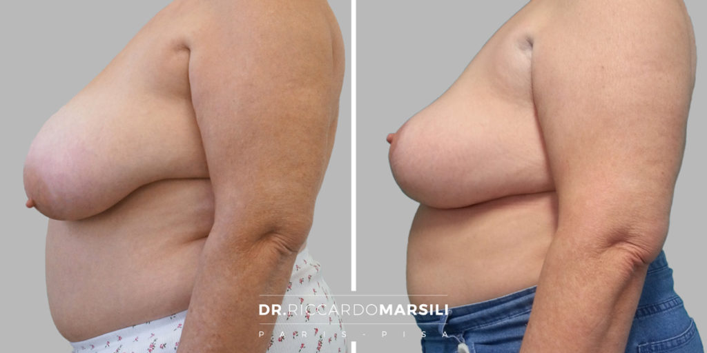 Corriger les seins tombants grâce à la technique de la mastopexie à paris