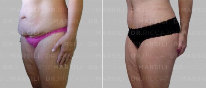 chirurgie-esthetique-ventre-abdominoplastie-paris-pise Abdominoplastie Paris