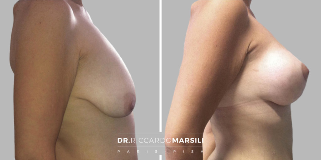 ptose mammaire Paris